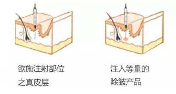 B****除皱多久打一次