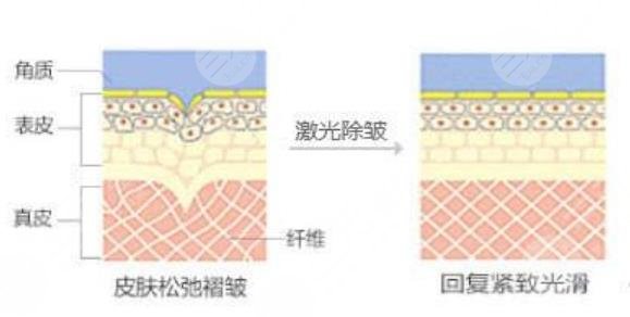 激光除皱