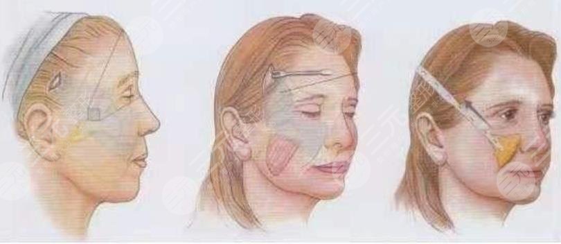 中面部抗衰术的费用怎么样