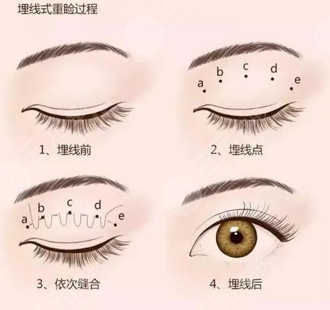 埋线双眼皮原理