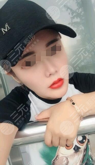 真人B****除皱后6个月