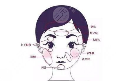 玻尿酸除皱的价格