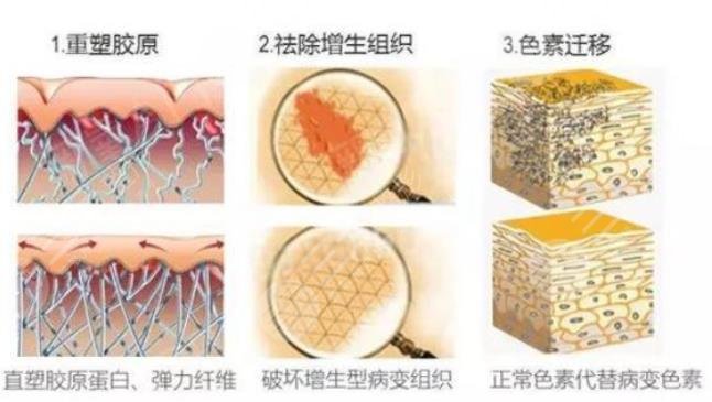 欧洲之星点阵激光