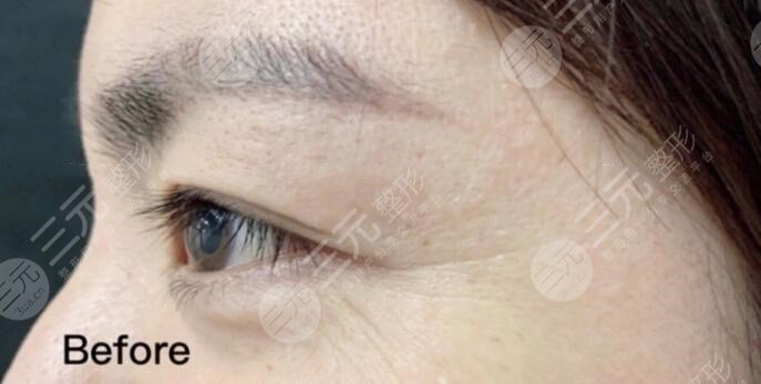 注射注射除皱前