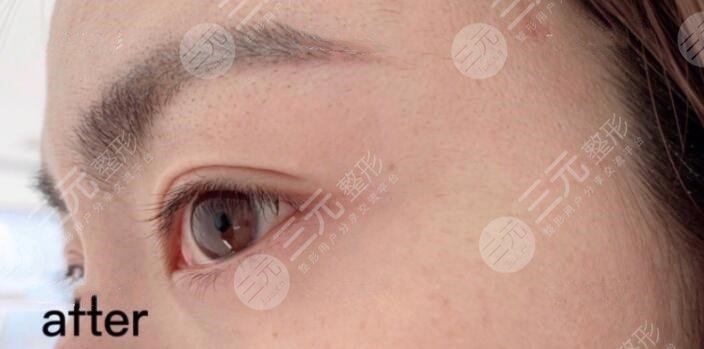 注射注射除皱后