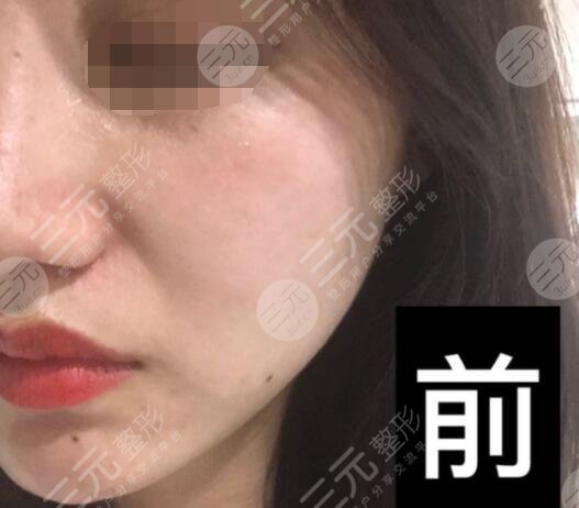 真人体验激光除皱前