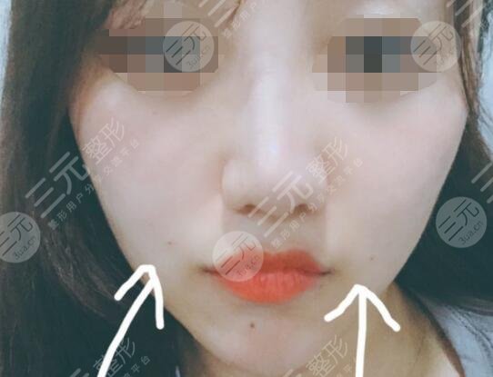 真人体验激光除皱后