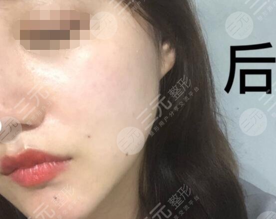 真人体验激光除皱后 果