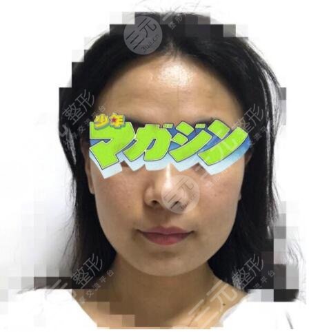 真人展示注射除皱前