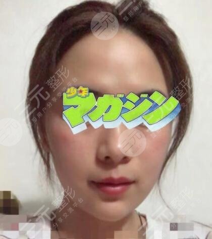 真人展示注射除皱后一个月