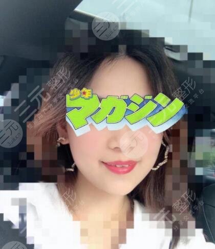 真人展示注射除皱后果