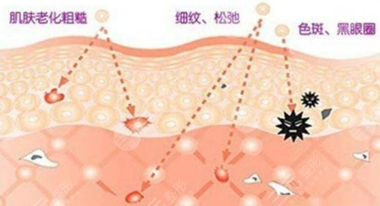 做激光除皱的注意事项