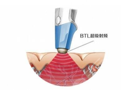 btl射频紧肤原理