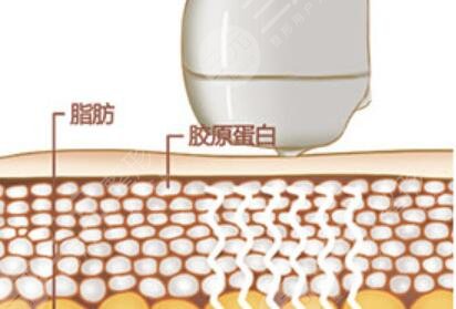 btl射频紧肤提拉怎么样