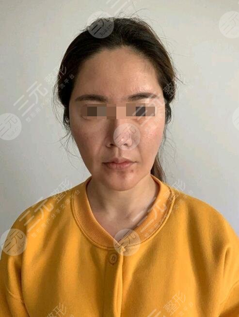 btl射频紧肤真人案例前