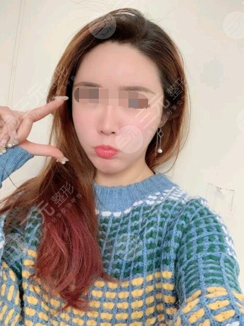 btl射频紧肤真人案例后一个月