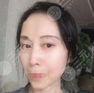 体验拉皮手术术后7周