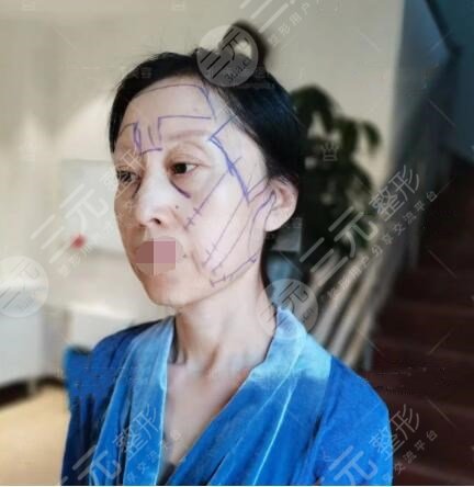 体验拉皮手术术前