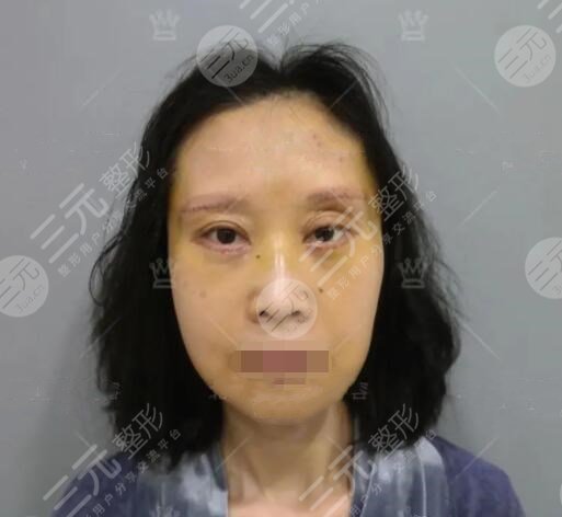体验拉皮手术术后一周