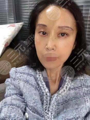 体验拉皮手术术后3周