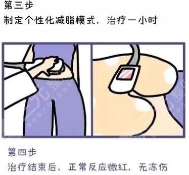 酷塑冷冻溶脂果会不会反弹