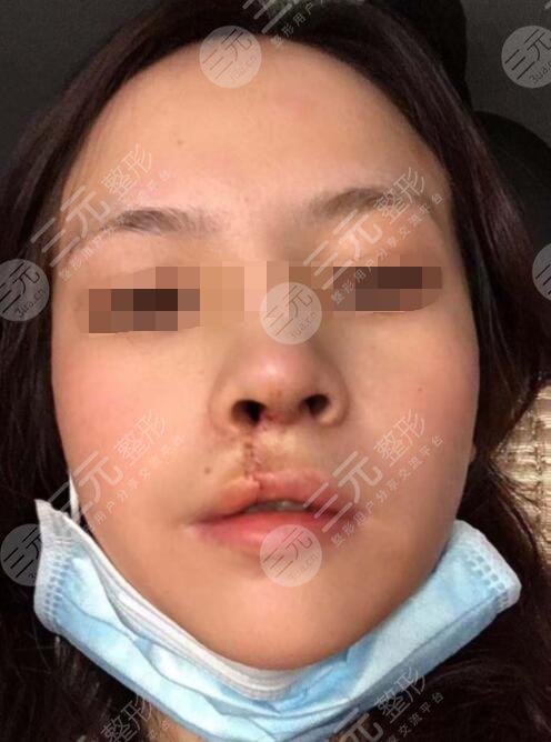 真人做兔唇修复后一个月