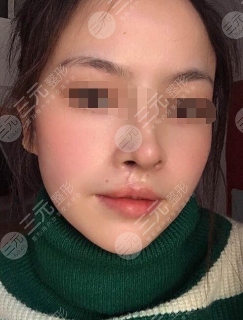 兔唇二期修复疤痕图片图片