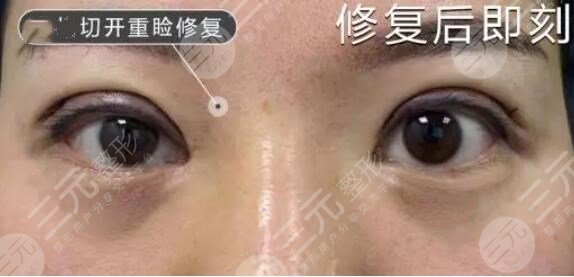 小姐姐做的双眼皮修复后一周