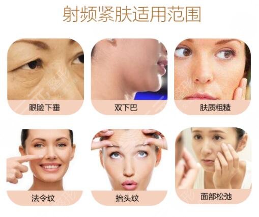 做射频紧肤的注意事项