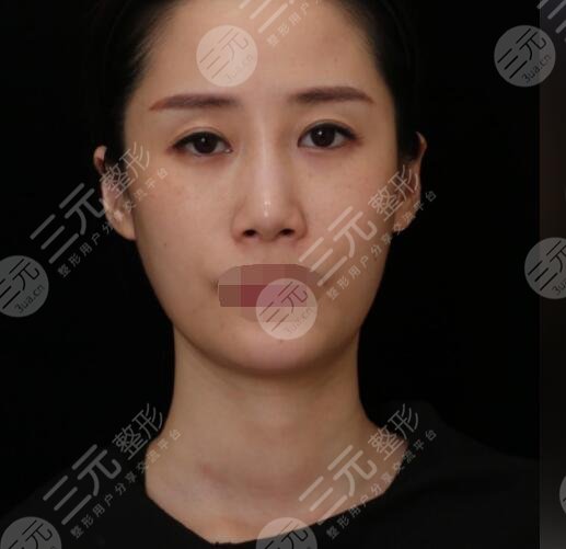 射频紧肤真人案例术前