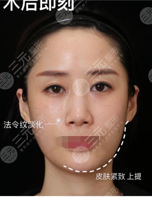 射频紧肤真人案例术后