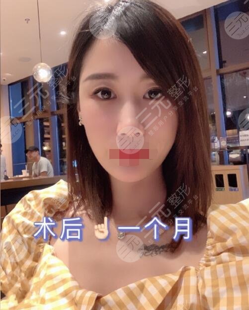 射频除皱手术后一个月