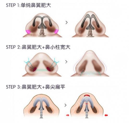 影响鼻翼缩小手术价格的因素