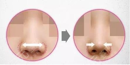鼻翼缩小手术的mz方式
