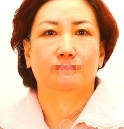 真人中面部抗衰术前