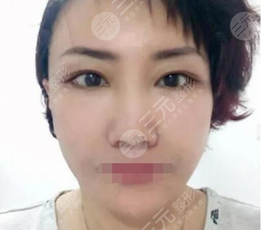 真人中面部抗衰术后一周