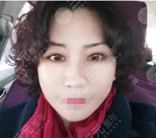 真人中面部抗衰术后5周