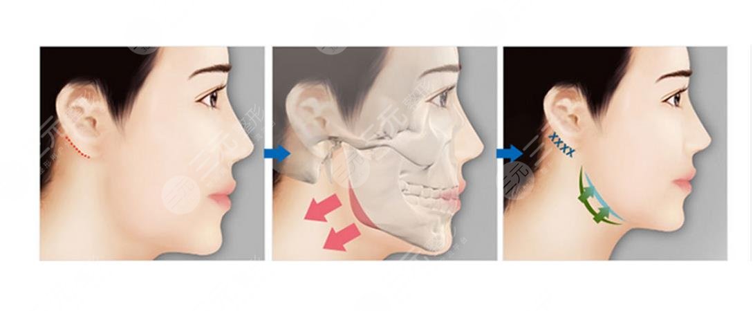 下颌角整形术后注意事项