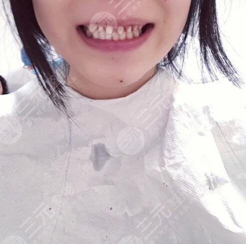 北京中诺口腔医院牙齿种植案例果图:术前