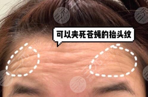 参考激光除皱