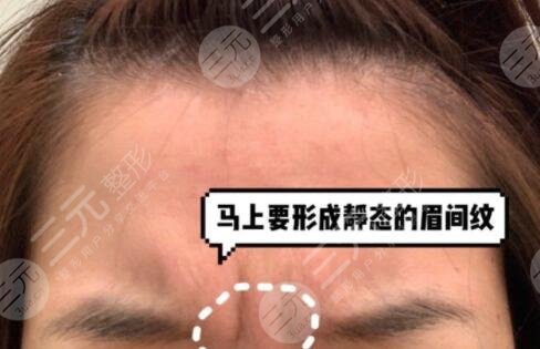 参考激光除皱术前