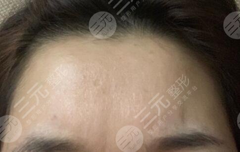 参考激光除皱术前