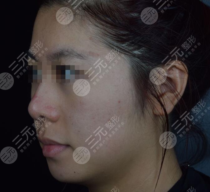 激光除皱术前