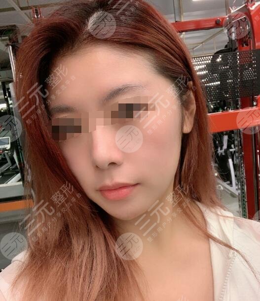 激光除皱术后半个月