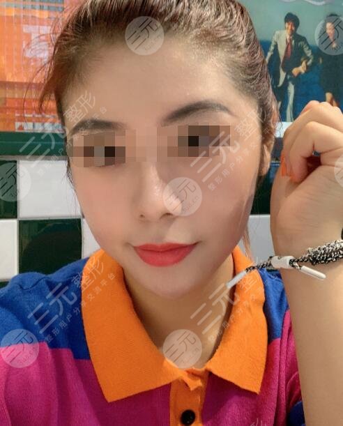 激光除皱术后1个月