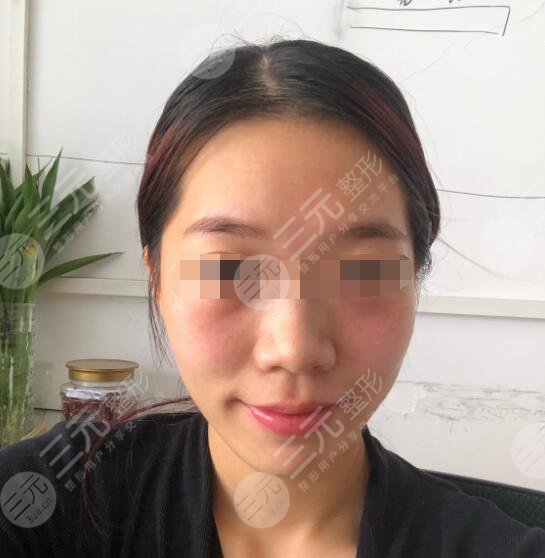 除皱案例后一周