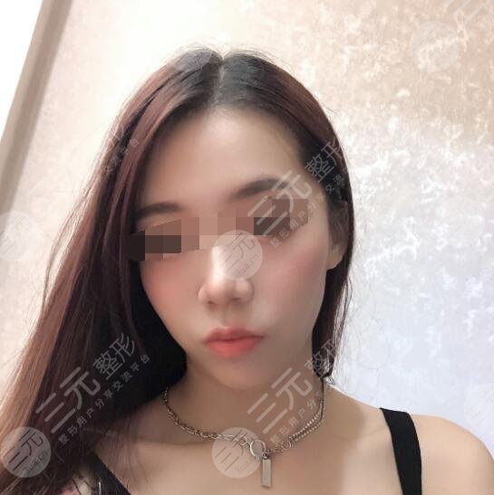 除皱案例后果