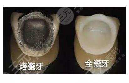 300元1颗的烤瓷牙图片怎么样附烤瓷牙及全瓷牙对比价格表