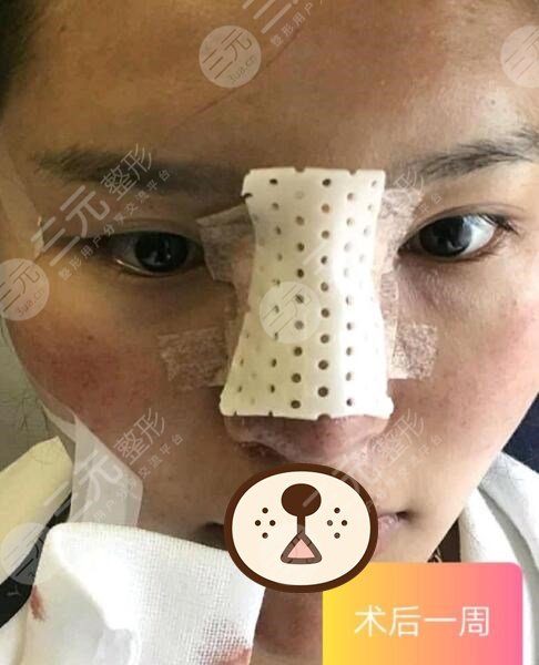 真人做隆鼻修复后一周