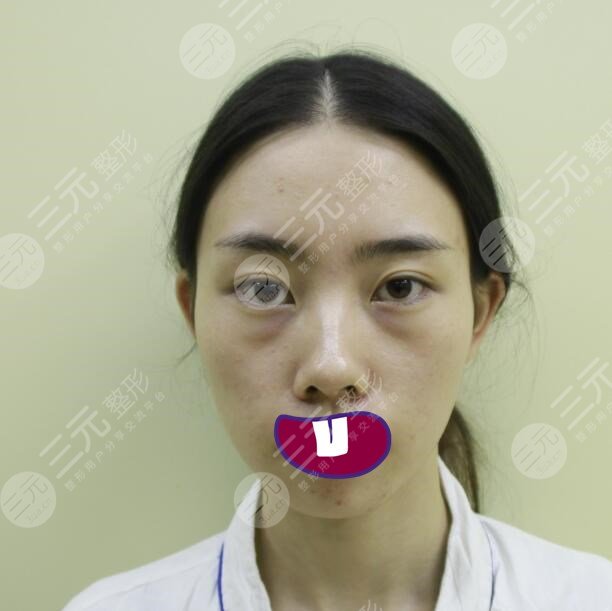 生物注射除皱网友体验果术前